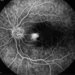 picture of retina